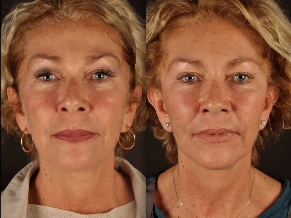 Teo Midface Lift result showing natural facial rejuvenation at Teo Clinic Istanbul