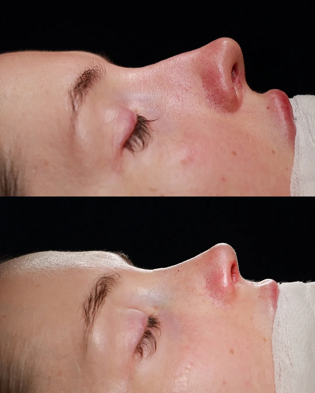 Revision rhinoplasty result at Teo Clinic Istanbul by Dr. Teoman Dogan
