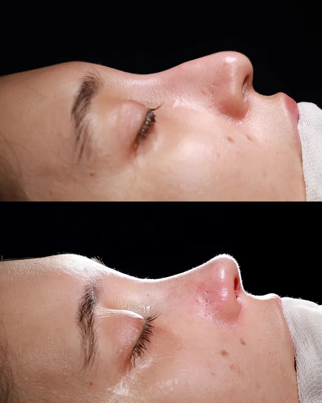 Ethnic rhinoplasty result preserving natural identity at Teo Clinic Istanbul by Dr. Teoman Dogan
