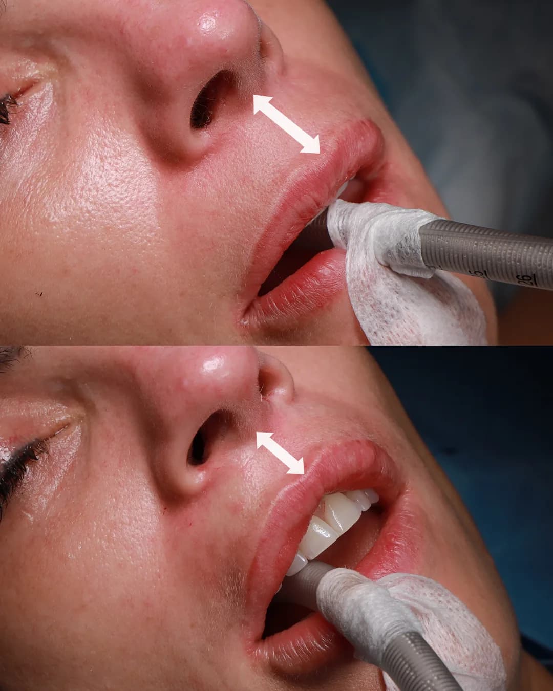 Combined lip lift and facelift result at Teo Clinic Istanbul showing full facial harmony