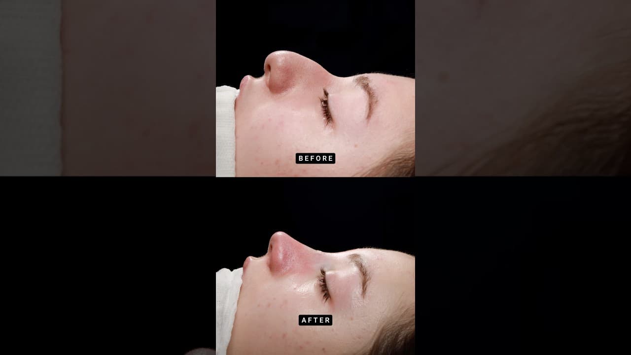 Primary Teorhinoplasty 👃