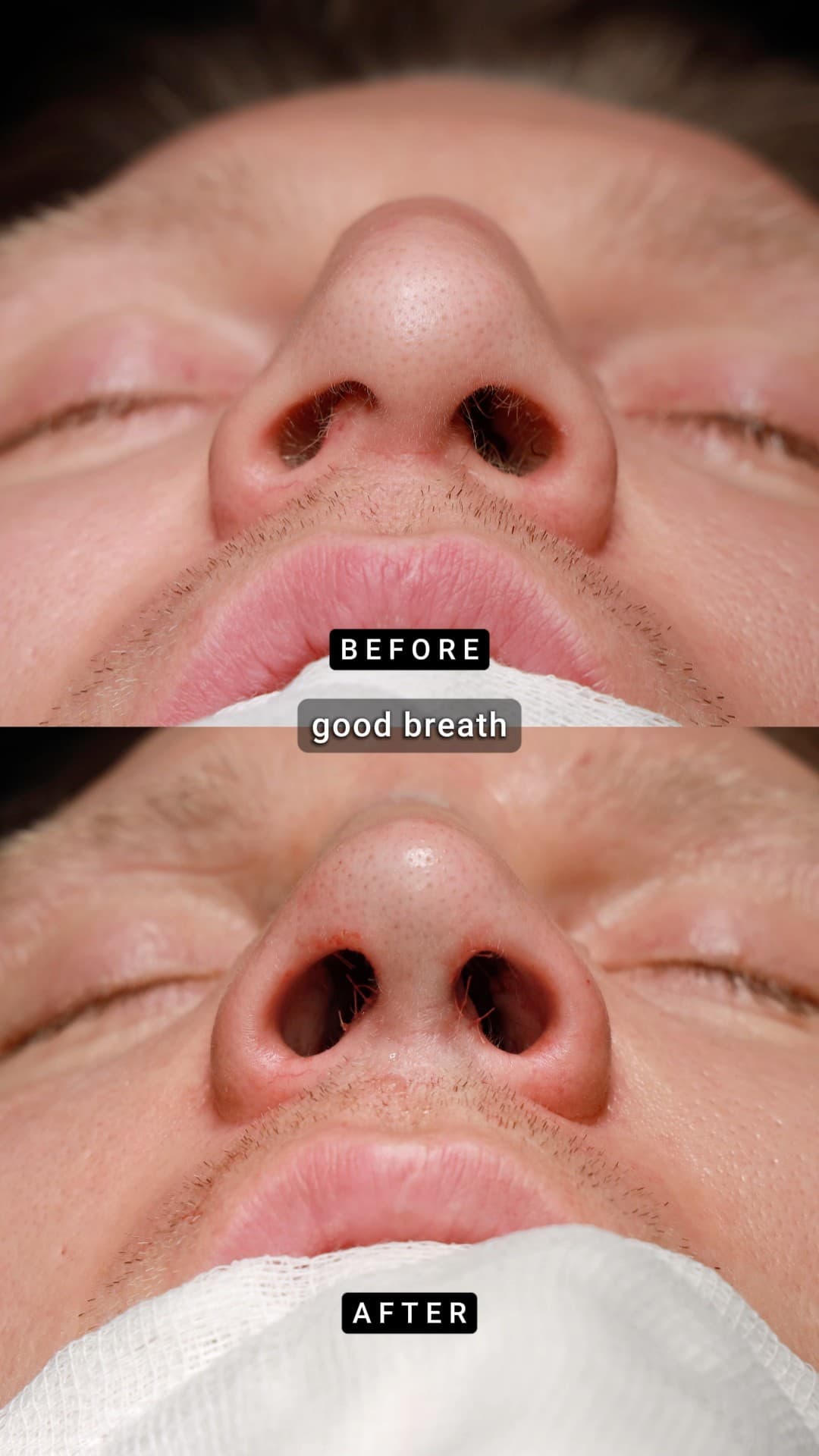 🥊 A Famous Boxer from Switzerland 🇨🇭 — Primary Male Teorhinoplasty