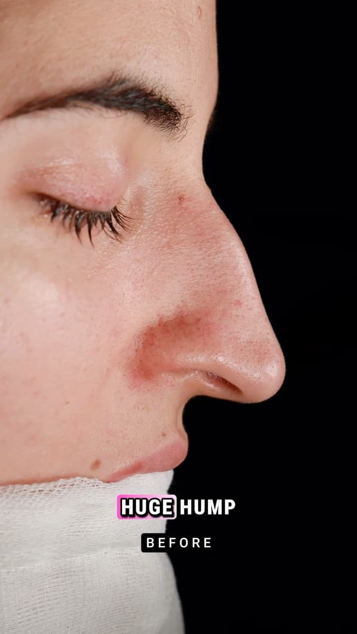 Closed Teorhinoplasty