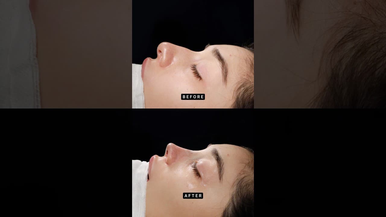 Primary Teorhinoplasty ✨💫👃