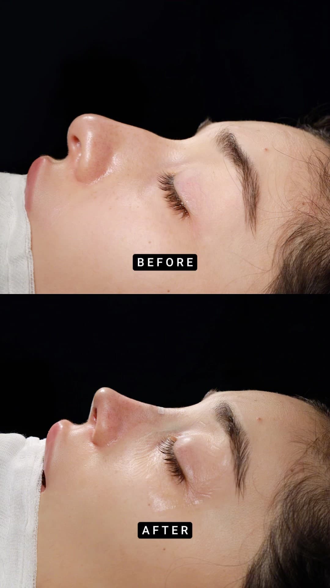 Primary Teorhinoplasty ✨💫👃