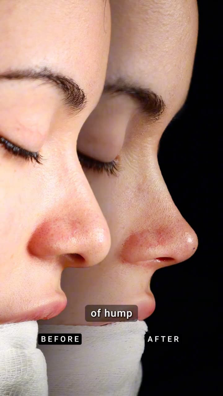 Primary Teorhinoplasty — 4 Year Result