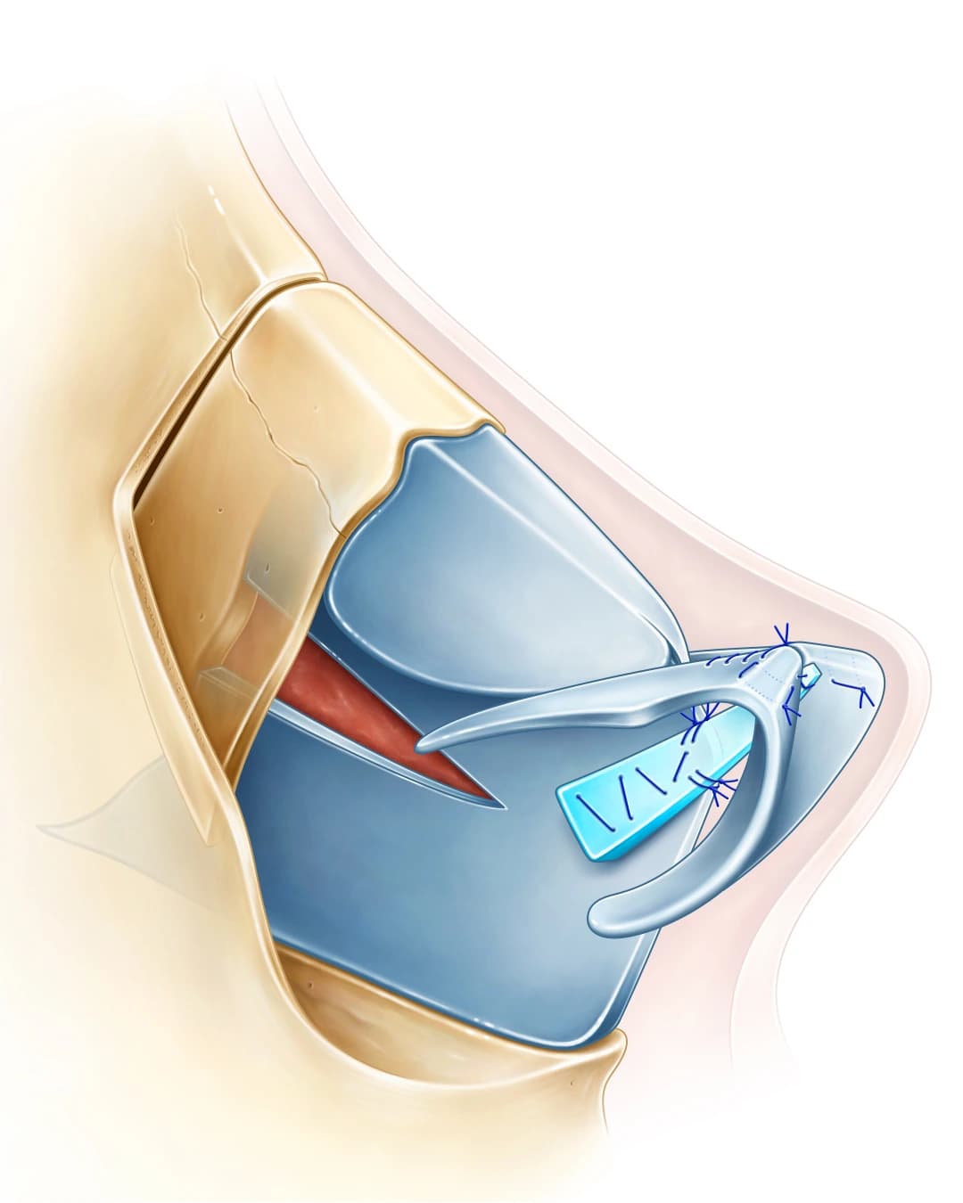 Surgical anatomy diagram of the nasal framework and cartilage grafts used in Teorhinoplasty